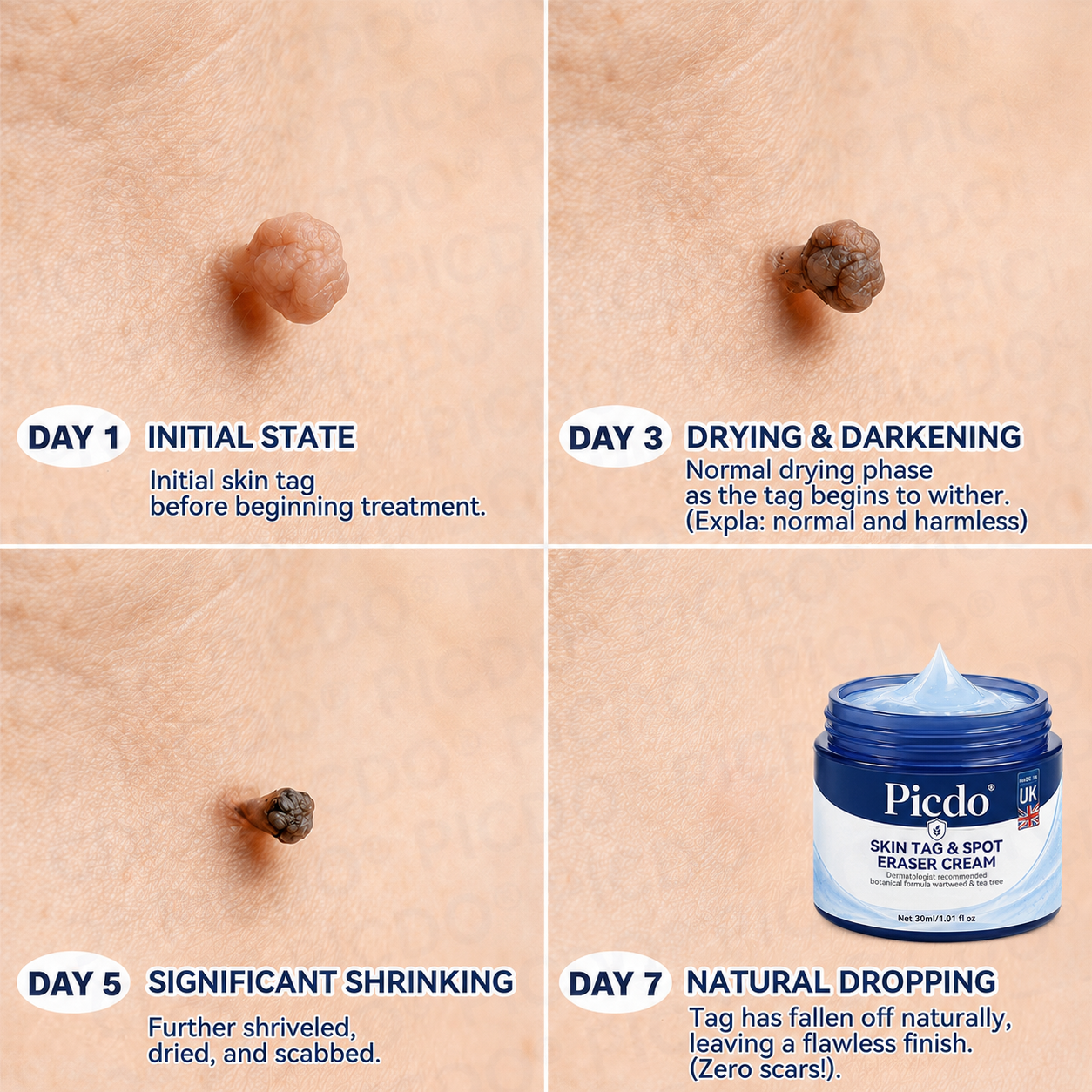 𝐏𝐢𝐜𝐝𝐨® 7-𝐃𝐚𝐲 𝐒𝐤𝐢𝐧 𝐓𝐚𝐠 & 𝐒𝐩𝐨𝐭 𝐄𝐫𝐚𝐬𝐞𝐫 𝐂𝐫𝐞𝐚𝐦 (Zero Pain, Zero 𝐒𝐜𝐚𝐫𝐬 Formula) 🔥