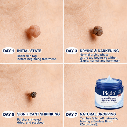 𝐏𝐢𝐜𝐝𝐨® 7-𝐃𝐚𝐲 𝐒𝐤𝐢𝐧 𝐓𝐚𝐠 & 𝐒𝐩𝐨𝐭 𝐄𝐫𝐚𝐬𝐞𝐫 𝐂𝐫𝐞𝐚𝐦 (Zero Pain, Zero 𝐒𝐜𝐚𝐫𝐬 Formula) 🔥
