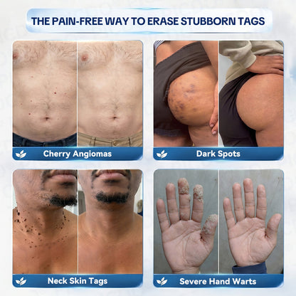 𝐏𝐢𝐜𝐝𝐨® 7-𝐃𝐚𝐲 𝐒𝐤𝐢𝐧 𝐓𝐚𝐠 & 𝐒𝐩𝐨𝐭 𝐄𝐫𝐚𝐬𝐞𝐫 𝐂𝐫𝐞𝐚𝐦 (Zero Pain, Zero 𝐒𝐜𝐚𝐫𝐬 Formula) 🔥