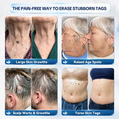 𝐏𝐢𝐜𝐝𝐨® 7-𝐃𝐚𝐲 𝐒𝐤𝐢𝐧 𝐓𝐚𝐠 & 𝐒𝐩𝐨𝐭 𝐄𝐫𝐚𝐬𝐞𝐫 𝐂𝐫𝐞𝐚𝐦 (Zero Pain, Zero 𝐒𝐜𝐚𝐫𝐬 Formula) 🔥