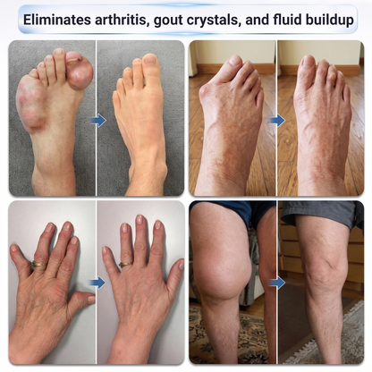 𝐼𝙁𝐌𝑨𝐆𝙄𝐂® ✅ 𝟬.𝟬𝟱𝗺𝗺 𝐌𝐢𝐜𝐫𝗼𝗻𝗲𝗲𝙙𝙡𝙚 𝑩𝒐𝒏𝒆 & 𝐉𝐨𝗶𝗻𝘁 𝗥𝗼𝗹𝗹𝒆𝙧🦵